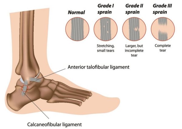 Перелом вывих растяжение