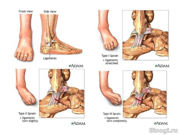 Растяжение связок голеностопа мазь
