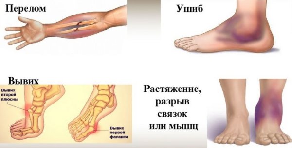 Повреждение связок суставов стопы