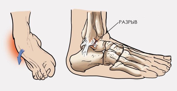 Порядок оказания первой помощи растяжении связок