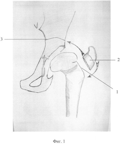 Вертлужная впадина тазобедренного сустава