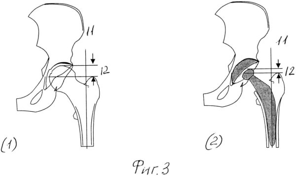 Угол Вайнберга тазобедренного сустава