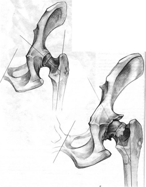 Репозиция тазобедренного сустава