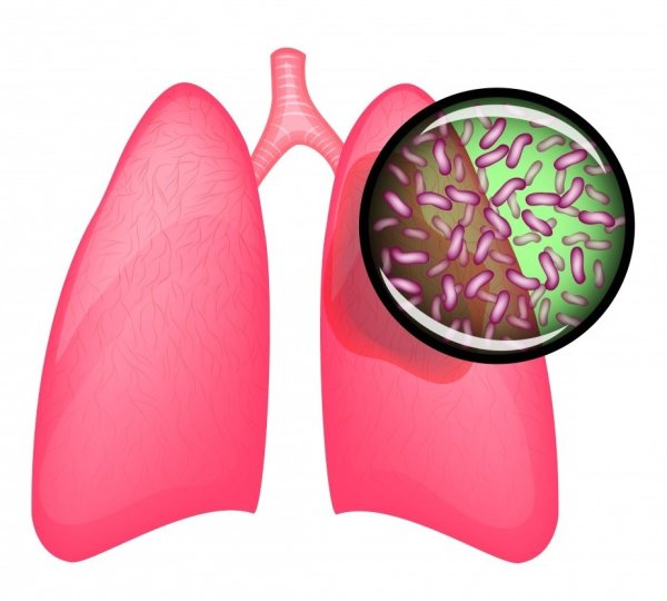 Микобактерии туберкулеза легкие