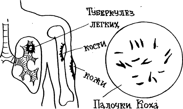 Возбудитель туберкулеза микробиология рисунок