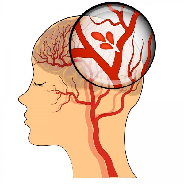 Инсульт на белом фоне