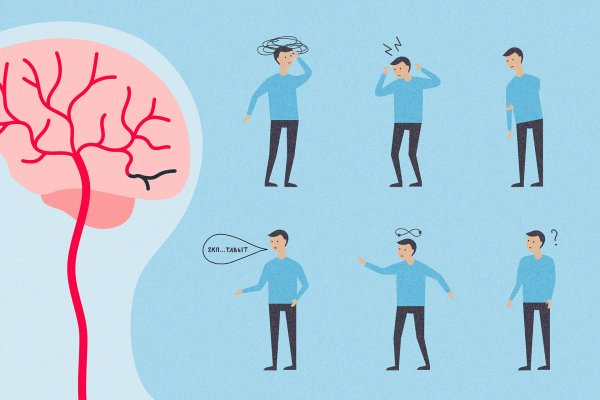 Медицина инсульт