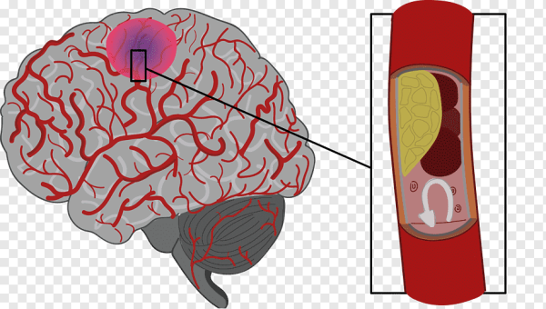 Инсульт клипарт