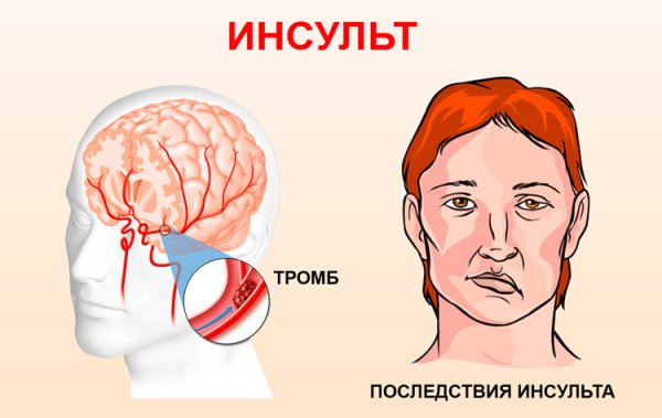 Презентация по теме инсульт