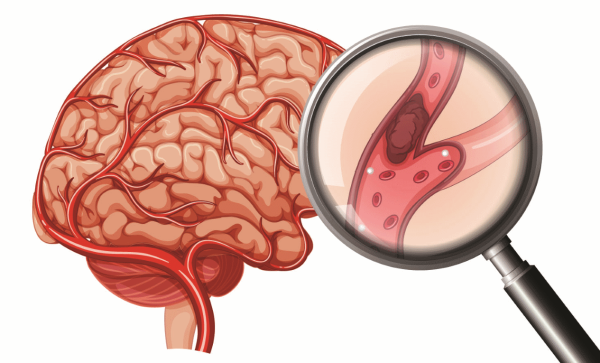 Памятка инсульт