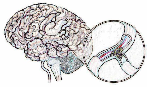 Признаки инсульта