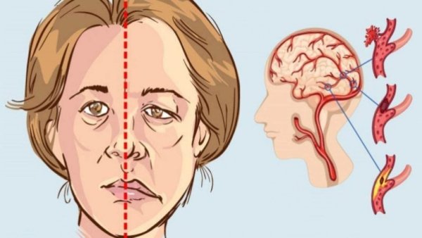 Инсульт картинки