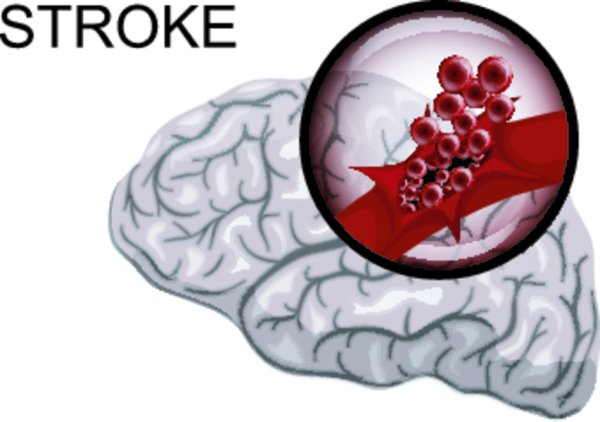 Обширный инсульт головного мозга