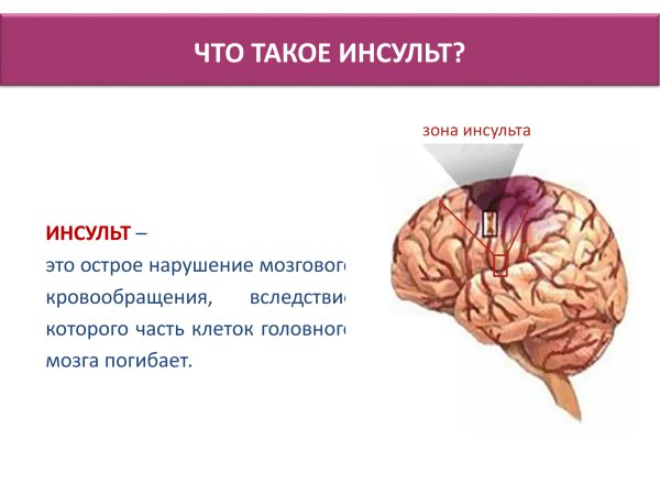 Острое нарушение головного кровообращения