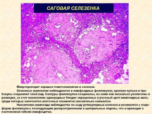 Амилоидоз селезенки макропрепарат