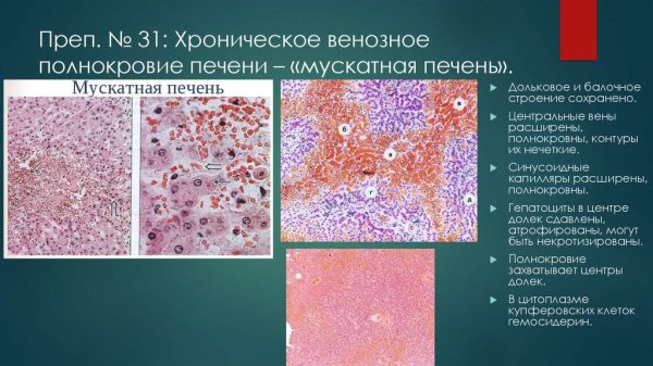 Хроническое венозное полнокровие печени микропрепарат