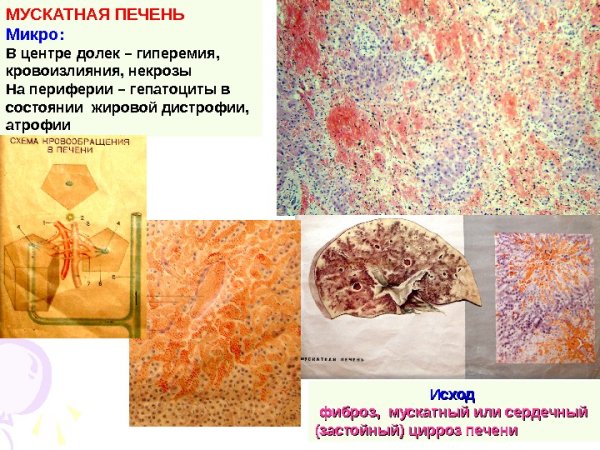 Мускатный цирроз печени микропрепарат