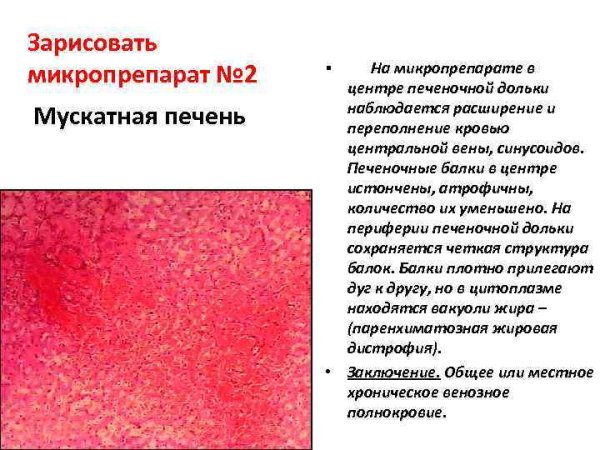 Препарат венозное полнокровие печени мускатная печень