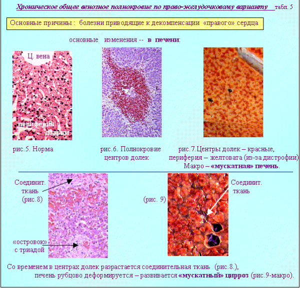 Мускатная печень патанатомия