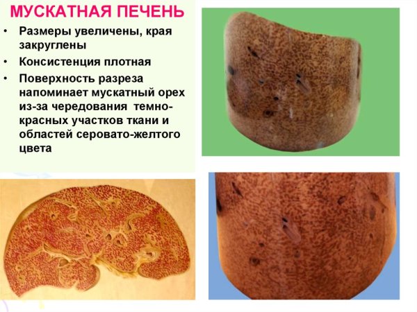 Хроническое венозное полнокровие печени