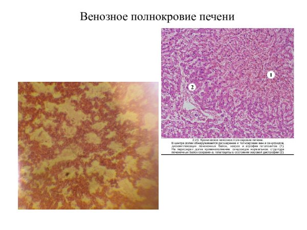 Мускатная печень патологическая анатомия