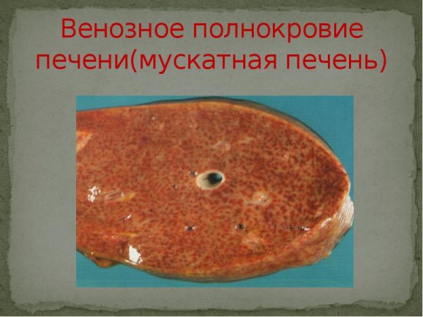 Венозное полнокровие печени микропрепарат