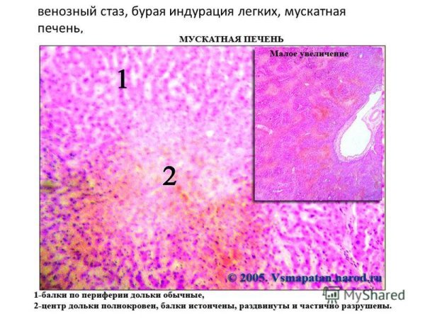 Мускатная печень патанатомия макропрепарат