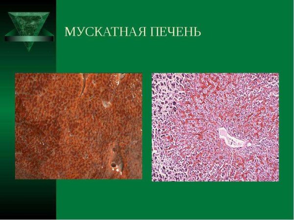 Венозное полнокровие печени микропрепарат