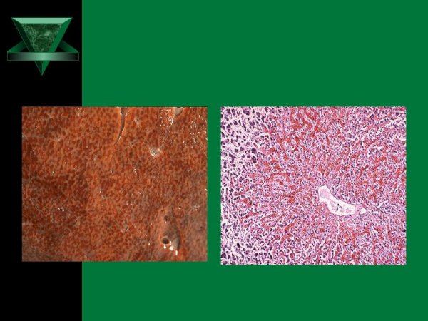 Мускатная печень микропрепарат