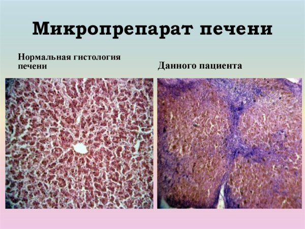 Мускатная печень микропрепарат