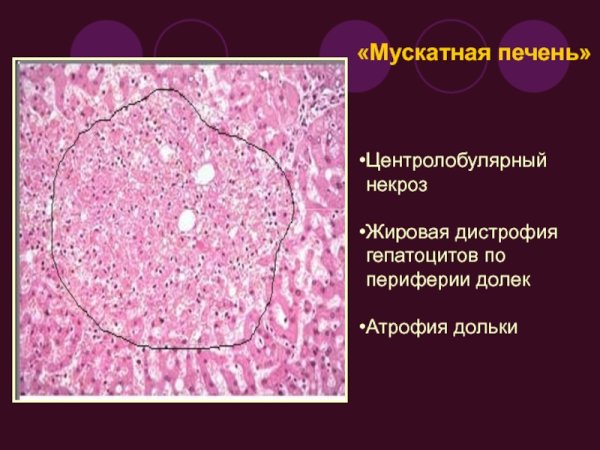 Мускатный цирроз печени