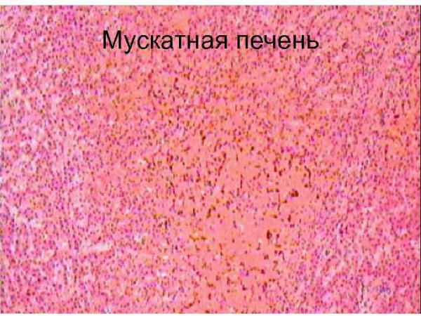 Острое венозное полнокровие патанатомия