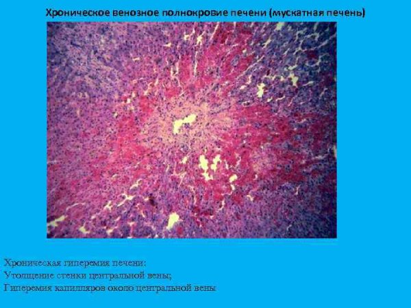 Мускатная печень (окраска гематоксилином-эозином).