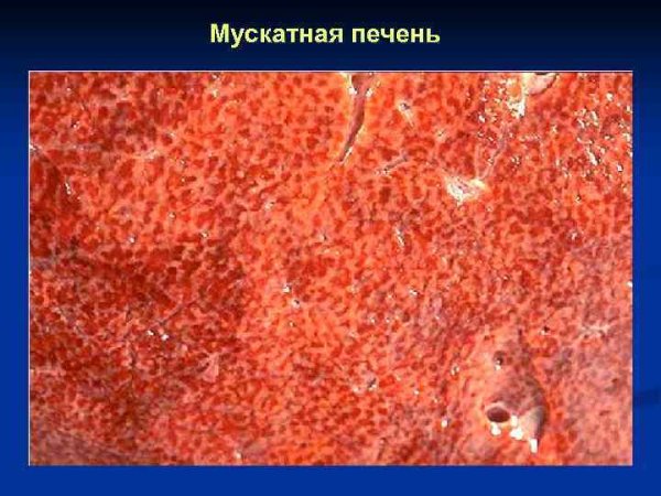 Хроническое венозное полнокровие печени