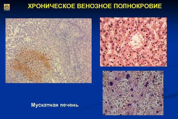 Мускатная печень патанатомия описание