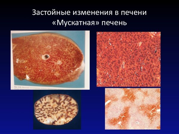 Хроническое венозное полнокровие печени мускатная печень