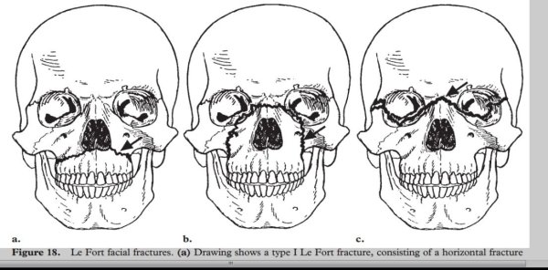 Скуловая кость вид снаружи и изнутри