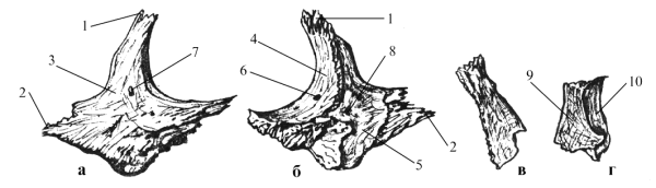 Суборбитальный перелом верхней челюсти