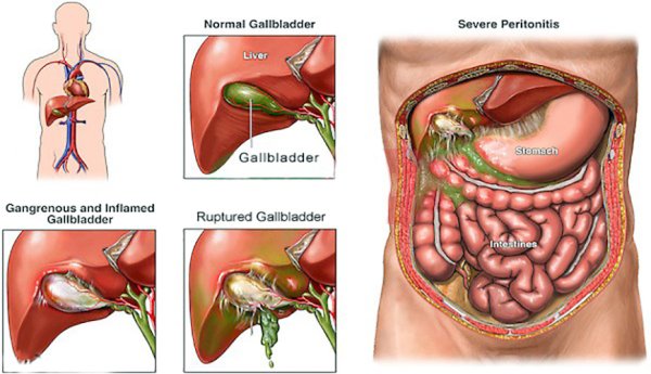 Острый холецистит перфорация желчного пузыря