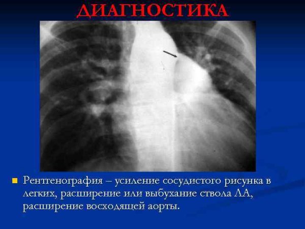 Выбухание дуги легочной артерии на рентгене
