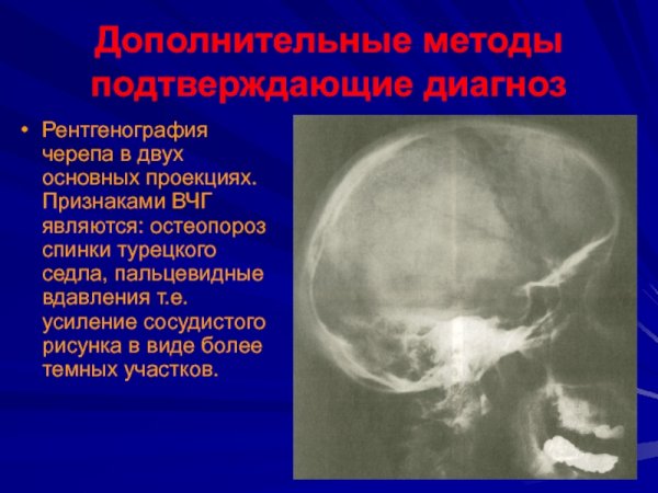 Усиление сосудистого рисунка легкого