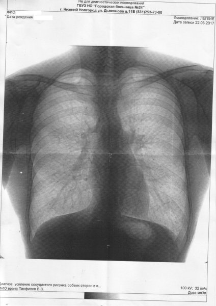 Легочный рисунок усилен