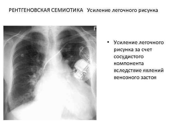 Лёгкие здорового человека флюорография