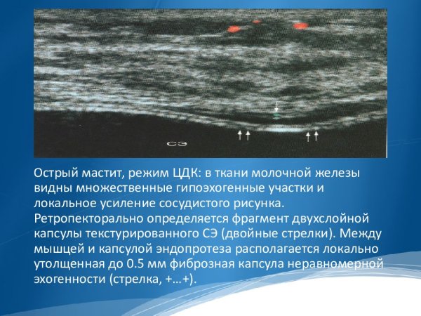 Нормальный легочный рисунок