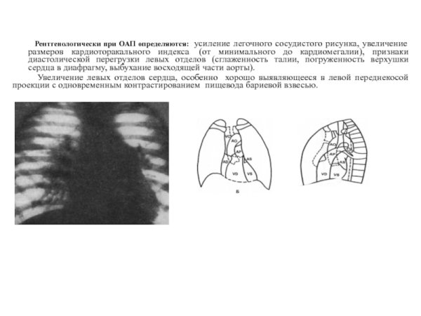 Синдром легочной диссеминации
