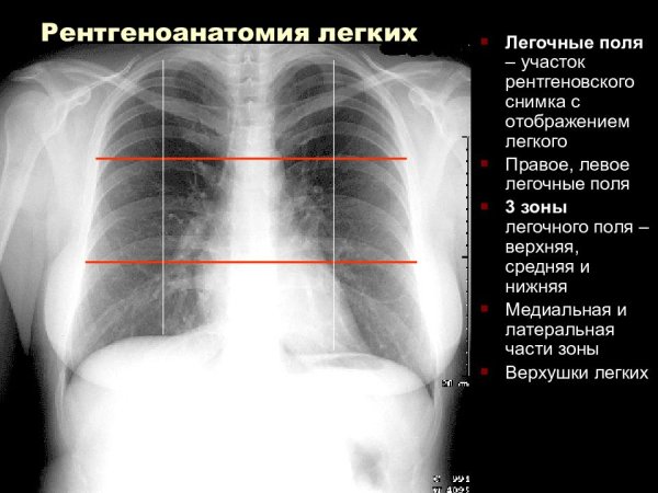 Усиление легочного рисунка