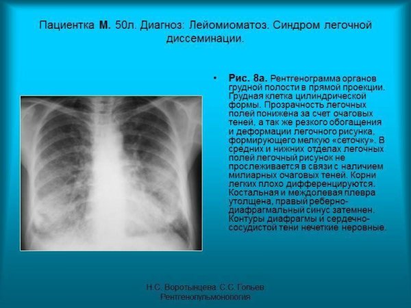 Синдром изменения легочного рисунка рентген