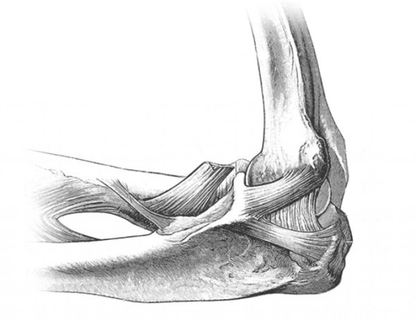 Посттравматическая контрактура локтевого сустава
