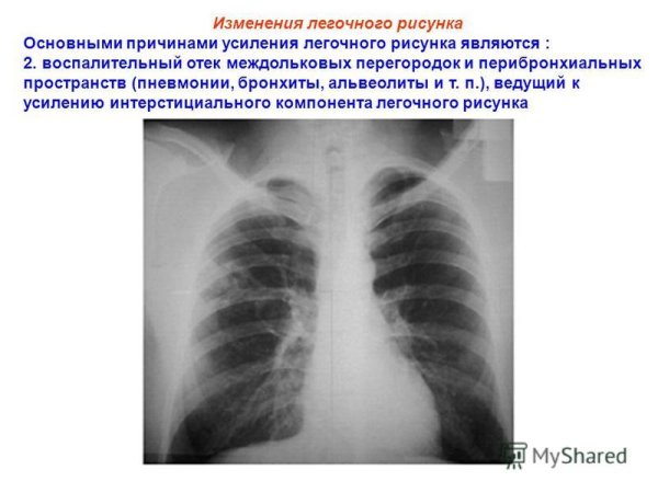 Усиление легочного рисунка