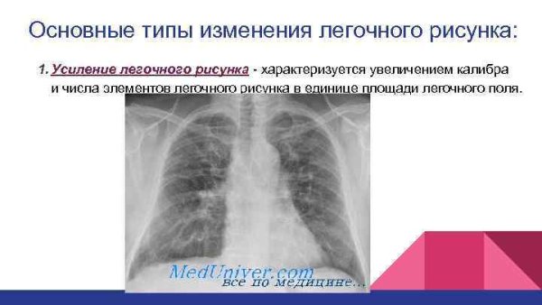 Ячеистое усиление легочного рисунка